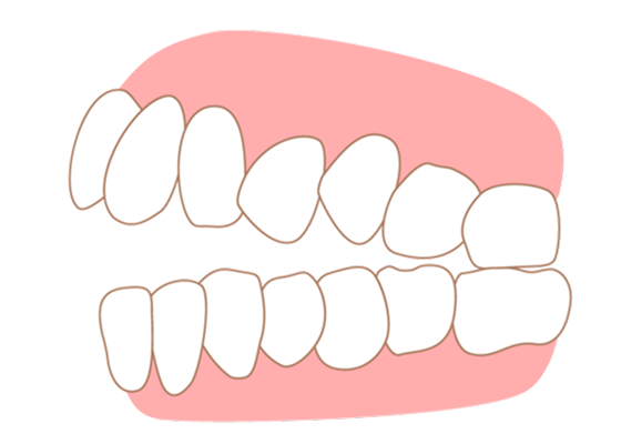 correction_teeth03