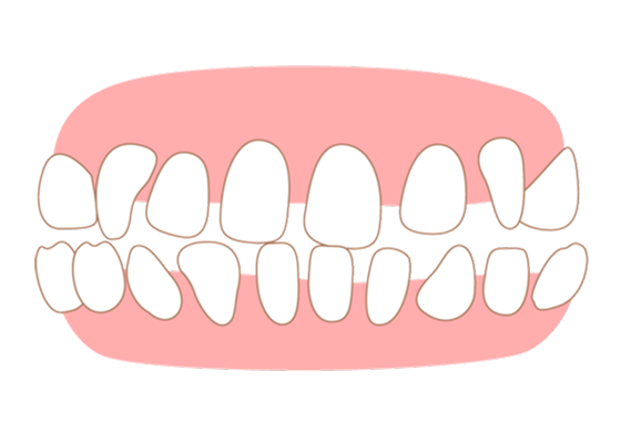 correction_teeth05